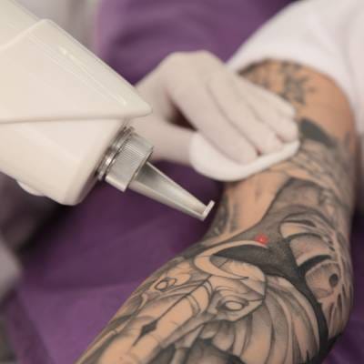 Eraserhead is a Tattoo Removal Company in Brattleboro, VT 05301